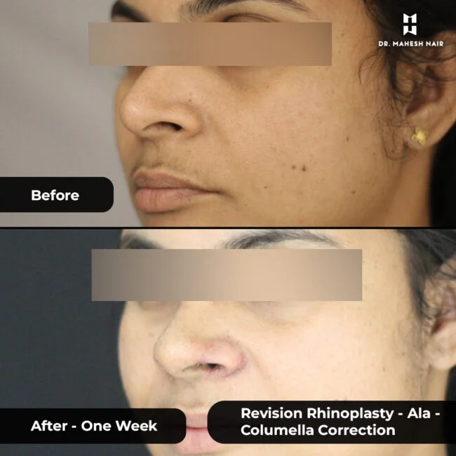 Deepa Biju rhinoplasty 2-01