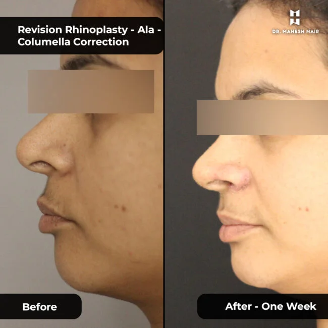 Deepa Biju rhinoplasty 3-01