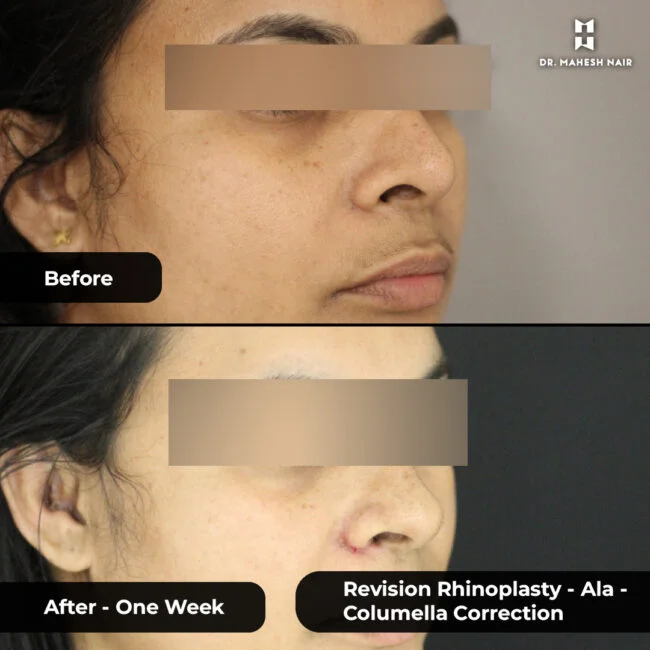 Deepa Biju rhinoplasty 4-01