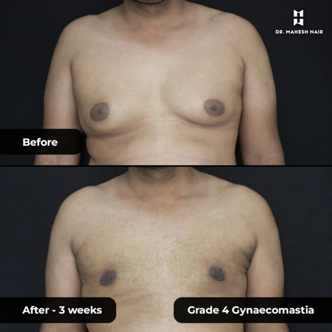 Jithesh grade 3_4 gynaecomastia 1-01