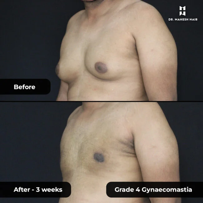 Jithesh grade 3_4 gynaecomastia 2-01