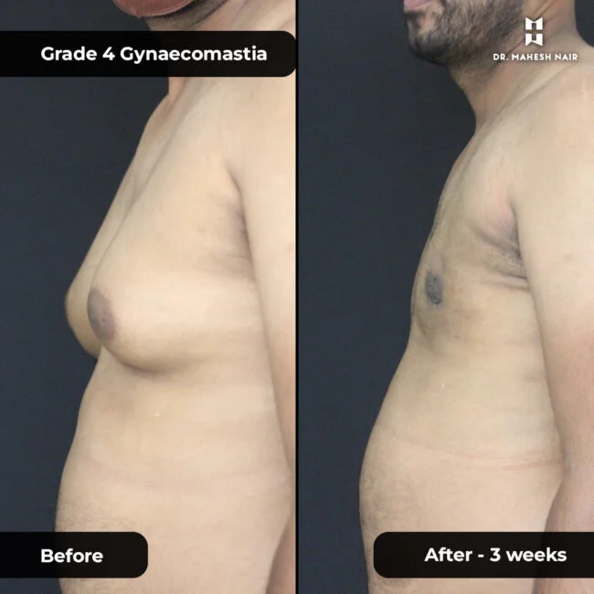 Jithesh grade 3_4 gynaecomastia 3-01