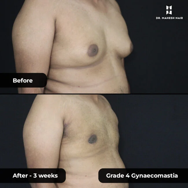 Jithesh grade 3_4 gynaecomastia 4-01