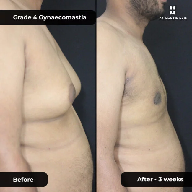 Jithesh grade 3_4 gynaecomastia 5-01