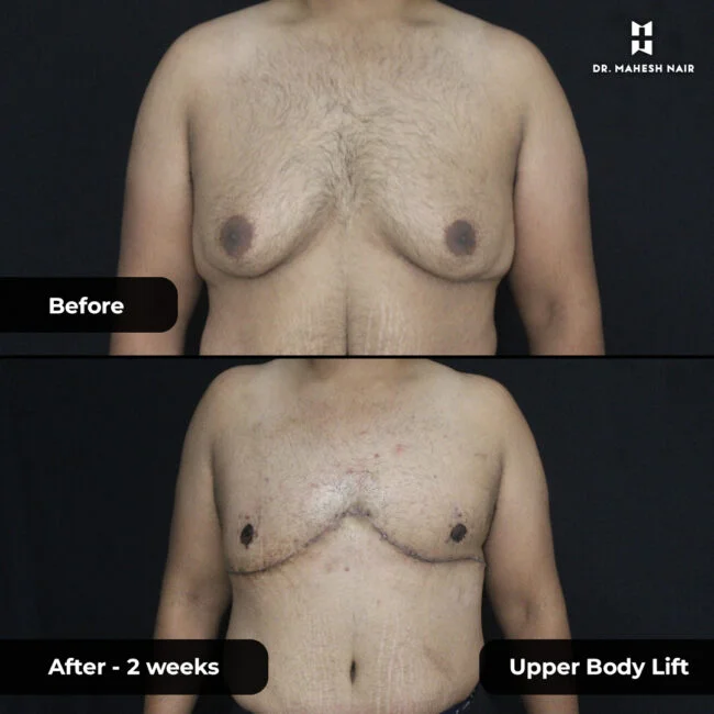 Nivu Hussain Upper Body Lift 1-01