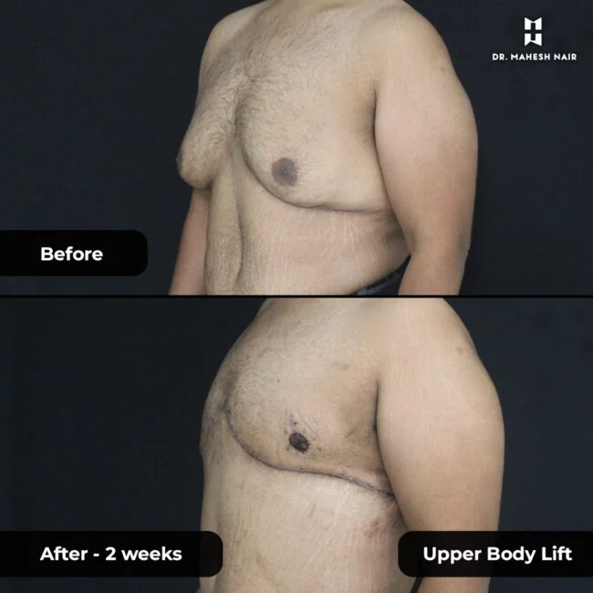 Nivu Hussain Upper Body Lift 2-01