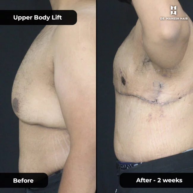 Nivu Hussain Upper Body Lift 4-01