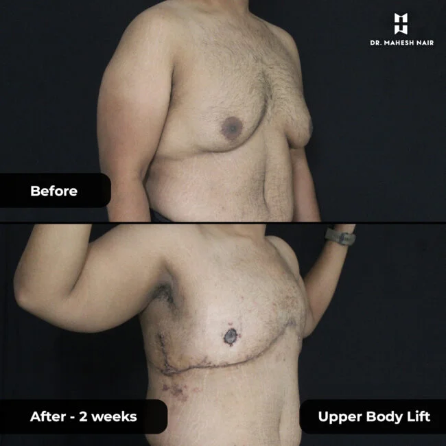 Nivu Hussain Upper Body Lift 5-01